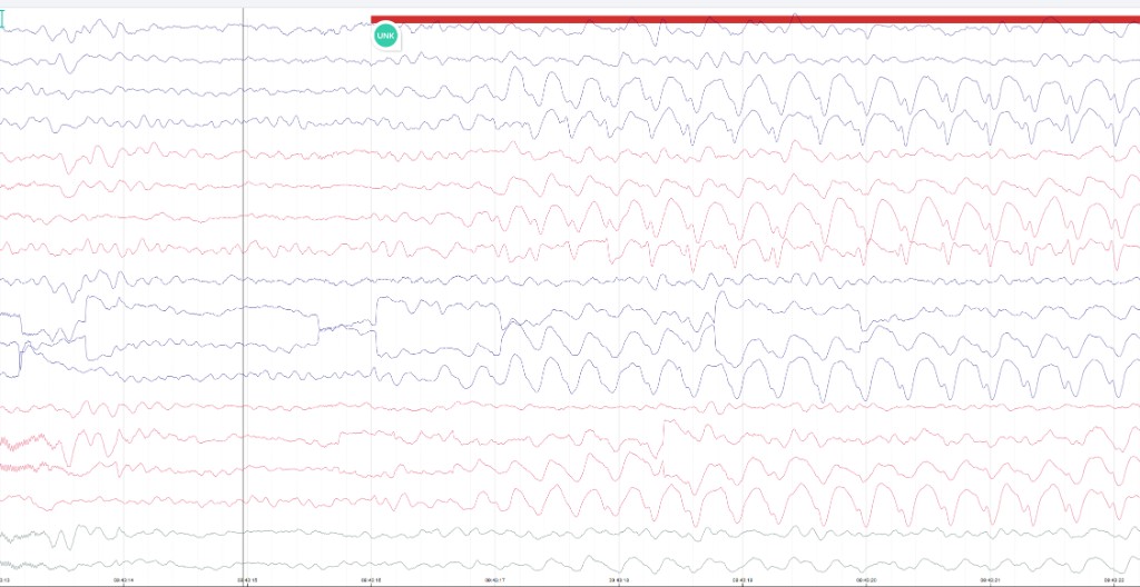 EEG snippet showing the start of a suspected seizure event